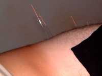 acupuncture